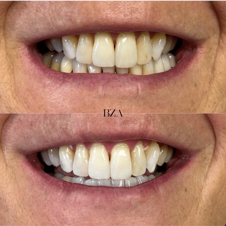After Image: Teeth Whitening - front