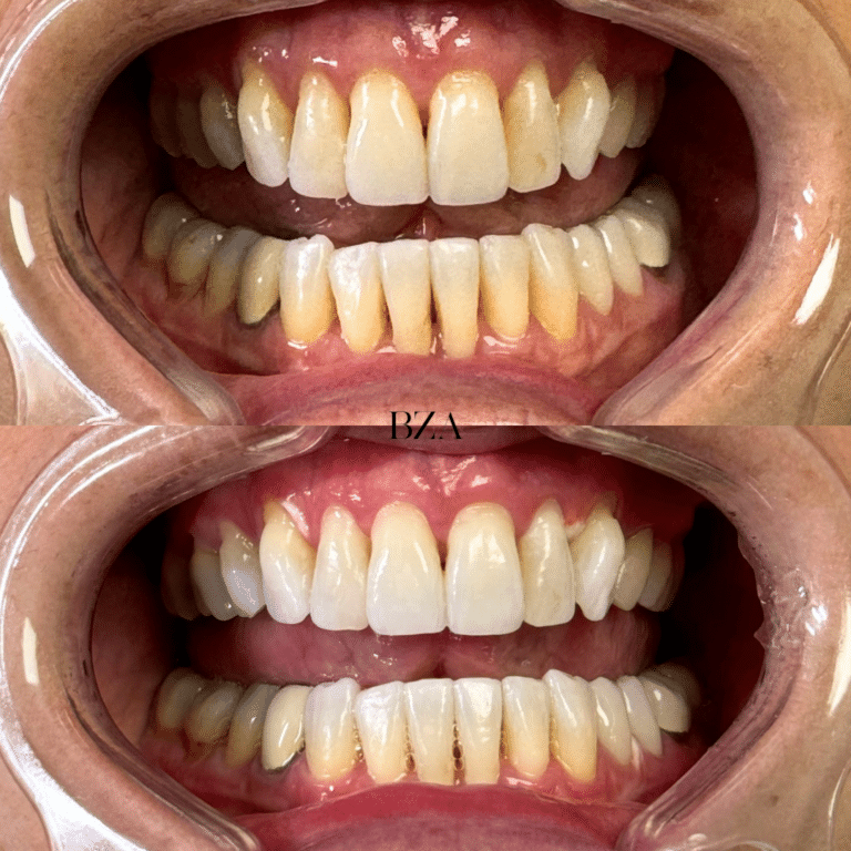 After Image: Teeth Whitening - front