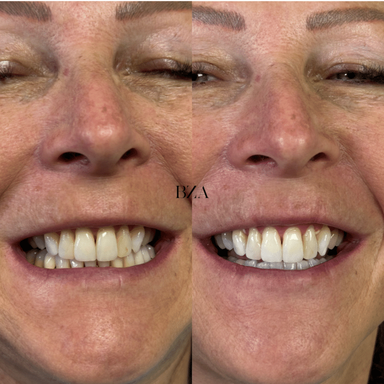 Before Image: Teeth Whitening - front