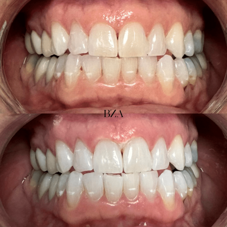 After Image: Teeth Whitening - front