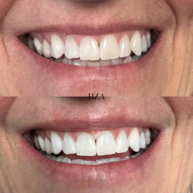 Before Image: Teeth Whitening - front