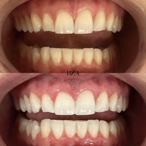 Before Image: Teeth Whitening