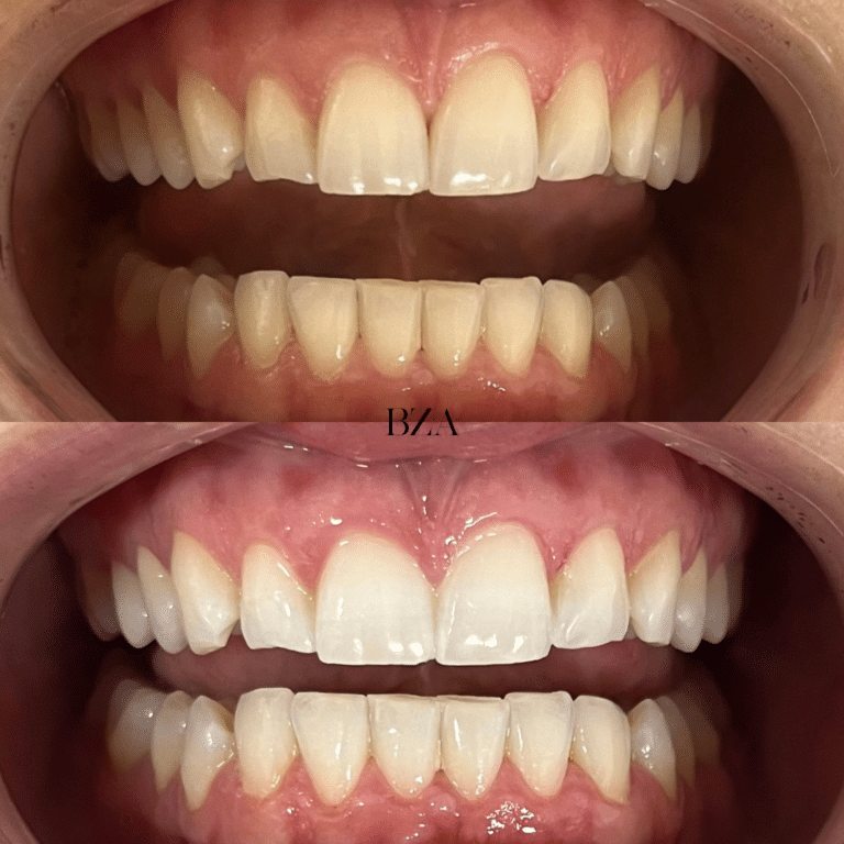 Before Image: Teeth Whitening - front